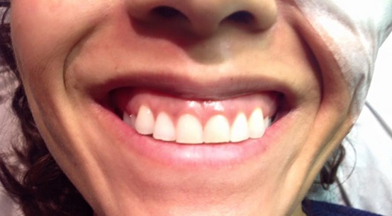 Gummy Smile before Botox treatment